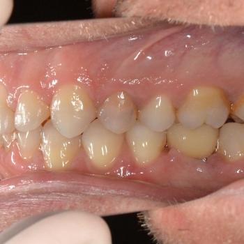 Kezelés után - jobb oldalról