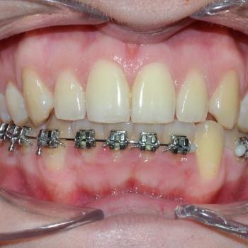 Kezelés előtt - szemből