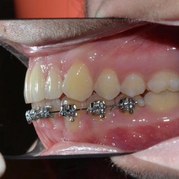 Kezelés előtt - jobb oldalról