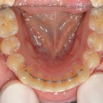 Kezelés után - alsó rágófelszín
